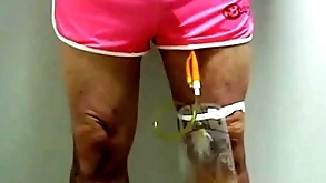 Catheter in the matter of accumulation sac away from pinky 396