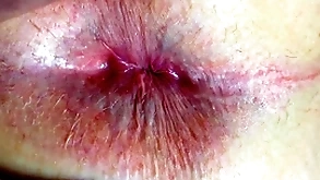 Nuisance plus anus closeup